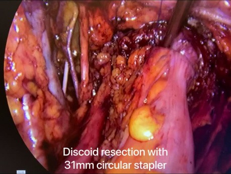 Resektion mit Hysterektomie bei tief infiltrierender Endometriose