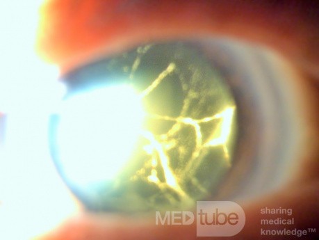 Vernachlässigter traumatischer Katarakt mit altem Hyphema