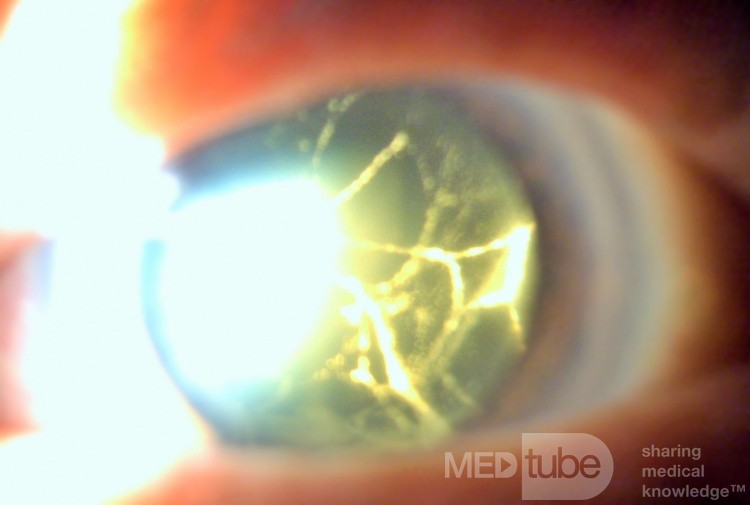 Vernachlässigter traumatischer Katarakt mit altem Hyphema