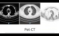 Anatomische roboterassistierte Segmentresektion (S2)