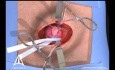 Inguinalhernie - ein offenes Verfahren - 3D-Animation