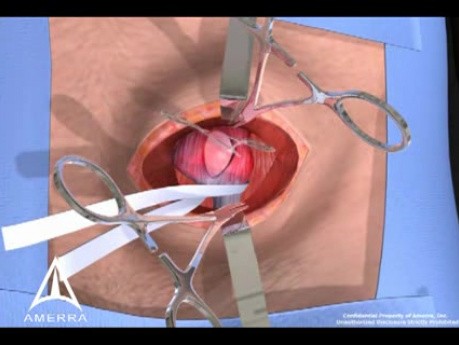 Inguinalhernie - ein offenes Verfahren - 3D-Animation