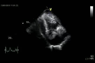  Herztamponade