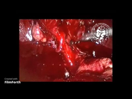 Laparoskopische Cholezystektomie bei akuter Cholezystitis