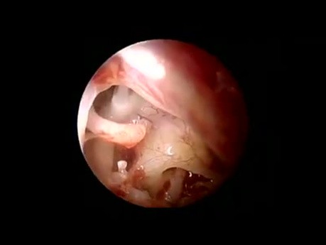 Endoskopische Stapedotomie bei Otosklerose