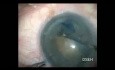 Therapie der Cataracta matura