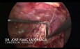 Laparoskopische Resektion der riesigen Peritonealzyste