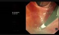 Endoskopische retrograde Cholangiopankreatikographie (ERCP) bei einem Patienten nach partieller Gastrektomie (Billroth II)