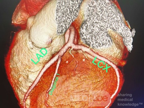 Mehrschicht-CT-Koronarangiographie