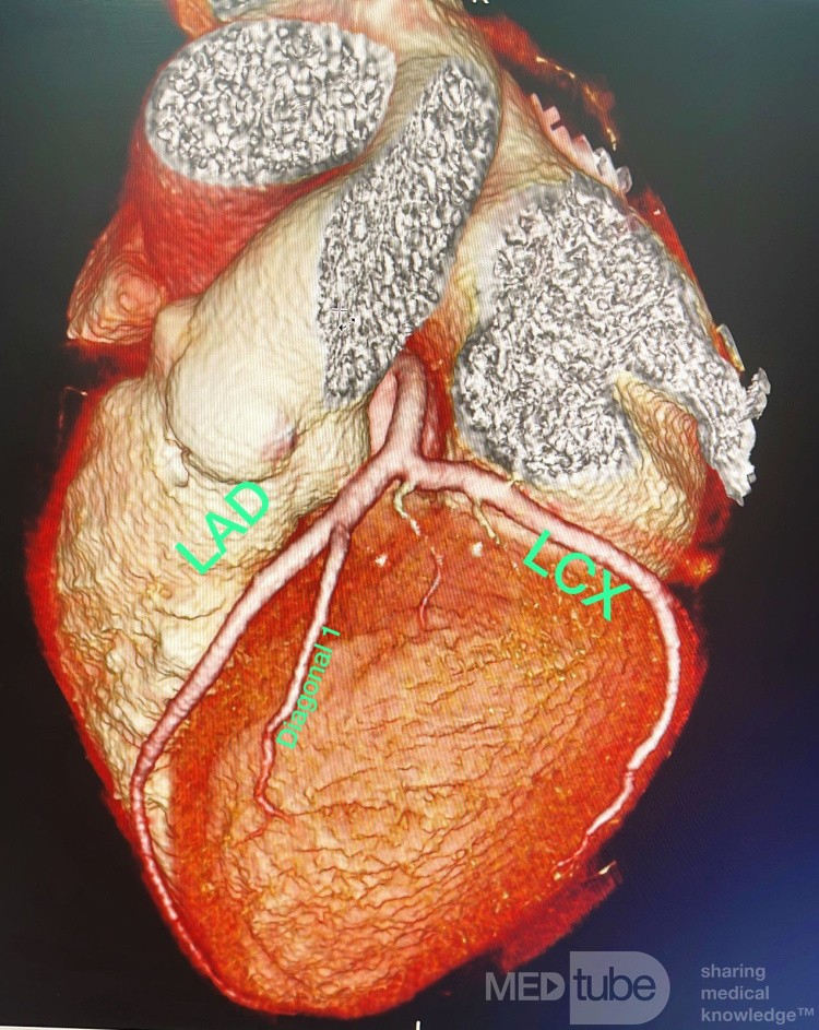 Mehrschicht-CT-Koronarangiographie