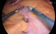 Roux-en-Y-Magenbypass mit Endohernia und Anwendung von Seprafilm