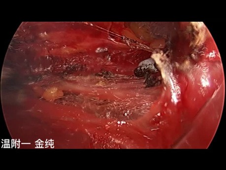 Dual-Port trans-subklavische endoskopische Schilddrüsenchirurgie (Teil 1)