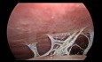 Adenokarzinom des Magens
