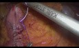 Intrakorporale Ileotransversostomie bei laparoskopischer Hemikolektomie rechts mit ICG-Perfusionstest