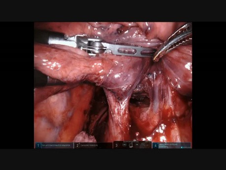 Bronchialkarzinom Lungenunterlappen - roboterassistierte Pneumonektomie