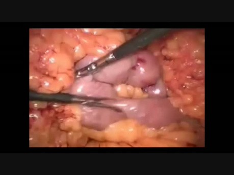 Laparoskopische Mini Magenbypass