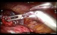 Anatomische Lungenresektion - Lingula schonende linke obere Lobektomie