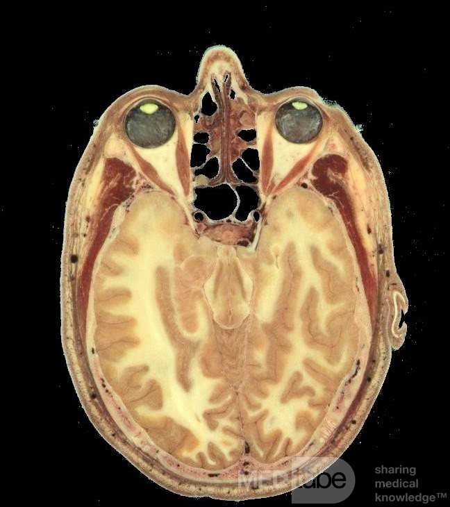 Die Beziehung zwischen der lateralen Wand der Siebbeinzellen und dem Musculus Rectus Medialis
