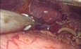 Laparoskopische Chirurgie für Ligamentum-arcuatum-Syndrom