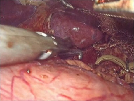 Laparoskopische Chirurgie für Ligamentum-arcuatum-Syndrom
