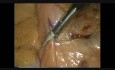 Laparoskopische Dissektion und Exposition von minderer Mesenterialarterie in der colo-rektalen Chirurgie bei Krebs