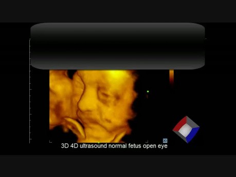 3D 4D-Ultraschallaufnahme von einem normalen Fötus mit geöffneten Augen