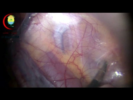 Laparoskopische Anatomie eines Leistenbruchs."