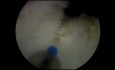 HoLEP mit Inzision eines Prostataabszesses
