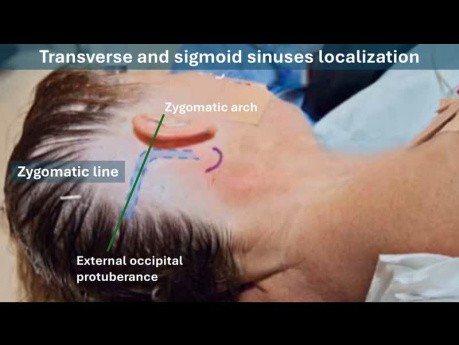 Lokalisierung des Sinus transversus und des Sinus sigmoideus