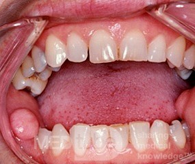 Fibroepithelialer Polyp Mundschleimhaut