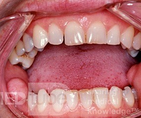 Fibroepithelialer Polyp Mundschleimhaut