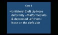 Einseitige Lippenspalten-Nasendeformität, Korrektur