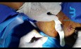 Lasertherapie bei Analfistel