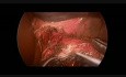 Laparoskopische Kardiomyotomie nach Heller bei einem 16-jährigen Patienten