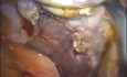 Laparo-endoskopische Einzelschnitt-Cholezystektomie (LESS)