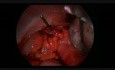 Laparoskopische Chirurgie- ein operatives Verfahren zur Behandlung von einer Ovarialtorsion