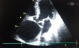 Aortendissektion Typ A nach Stanford – echokardiographische Darstellung