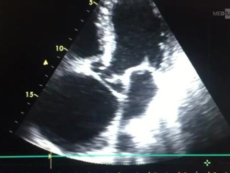Aortendissektion Typ A nach Stanford – echokardiographische Darstellung