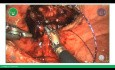Robotergestützte Prostatektomie