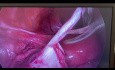 Laparoskopische Zystektomie des linken Eierstocks