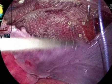 Die peritoneale Rekonstruktion bei der TAPP-Hernienversorgung zur Abdeckung des Netzes ist ein essenzieller Schritt