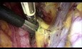 Die laparoskopische radikale Hysterektomie Typ B mit Isolierung des Zervixtumors