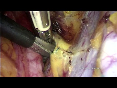 Die laparoskopische radikale Hysterektomie Typ B mit Isolierung des Zervixtumors