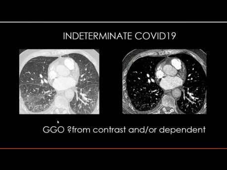 Diagnostische Bildgebung des Thorax für die Diagnose von COVID-19