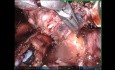 Bronchialtumor in schwieriger Lokalisation