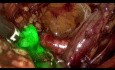 vNOTES Sentinel-Lymphknoten-Biopsie bei Endometriumkarzinom