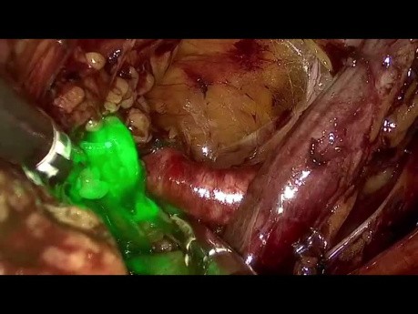 vNOTES Sentinel-Lymphknoten-Biopsie bei Endometriumkarzinom
