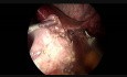Magensleeve-Resektion nach dem Misserfolg der bariatrischen Operation mit dem gastrischen Band.