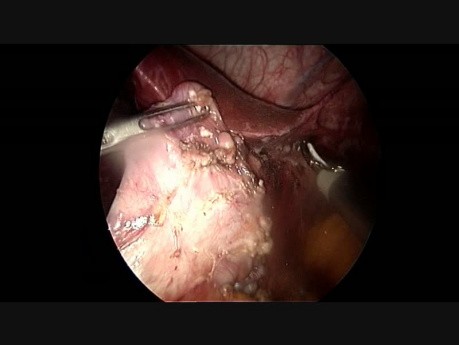 Magensleeve-Resektion nach dem Misserfolg der bariatrischen Operation mit dem gastrischen Band.