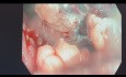 Endoskopische Mukosa Resektion (EMR) des Rektumpolypen